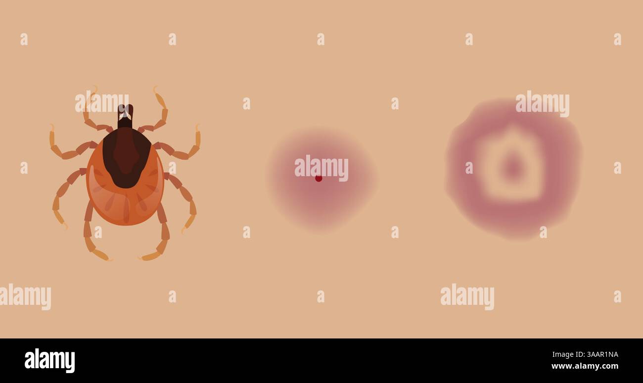 Progression der Lyme-Borreliose, mit einer Zecke, Bissmark, expandierenden kreisförmigen Ausschlag, Erythema migrans auf der Haut Stock Vektor