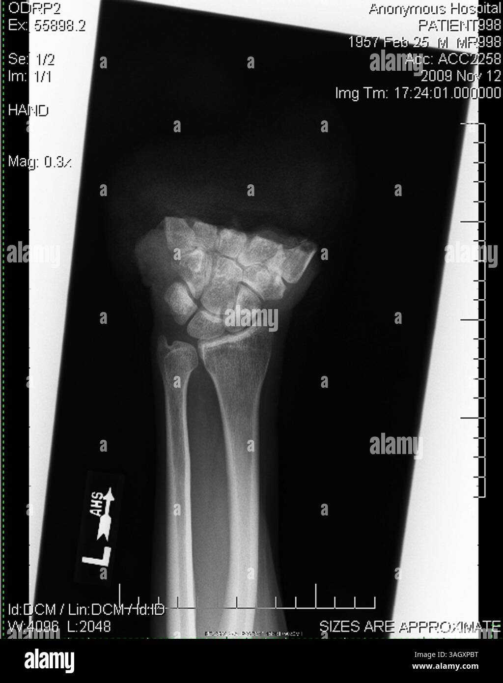 18. Dezember 2009 – Gilbert, Arizona, USA – Ärzte sagen, dass Timothy Blazer durch schnelles Denken seine linke Hand wieder befestigen konnte, nachdem er sie versehentlich mit einer Gehrungssäge durchtrennt hatte. Blazer, 52 Jahre alt, Schnitt ihm die linke Hand ab, während er an Schränken in seinem Haus in Gilbert, Arizona arbeitete. Nach dem Unfall hatte Blazer die Geistesgegenwart, seine abgetrennte Hand zu heben und sie auf Eis zu legen. Blazer sagt, dass sein Hintergrund bei den Pfadfindern und seine Ausbildung als Sicherheitsdirektor für Macy's ihm geholfen haben, ruhig zu bleiben. Chirurgen am Scottsdale Healthcare Hospital haben die Hand in einer vierstündigen Operation wieder befestigt und er hat Bewegung in allen Stockfoto