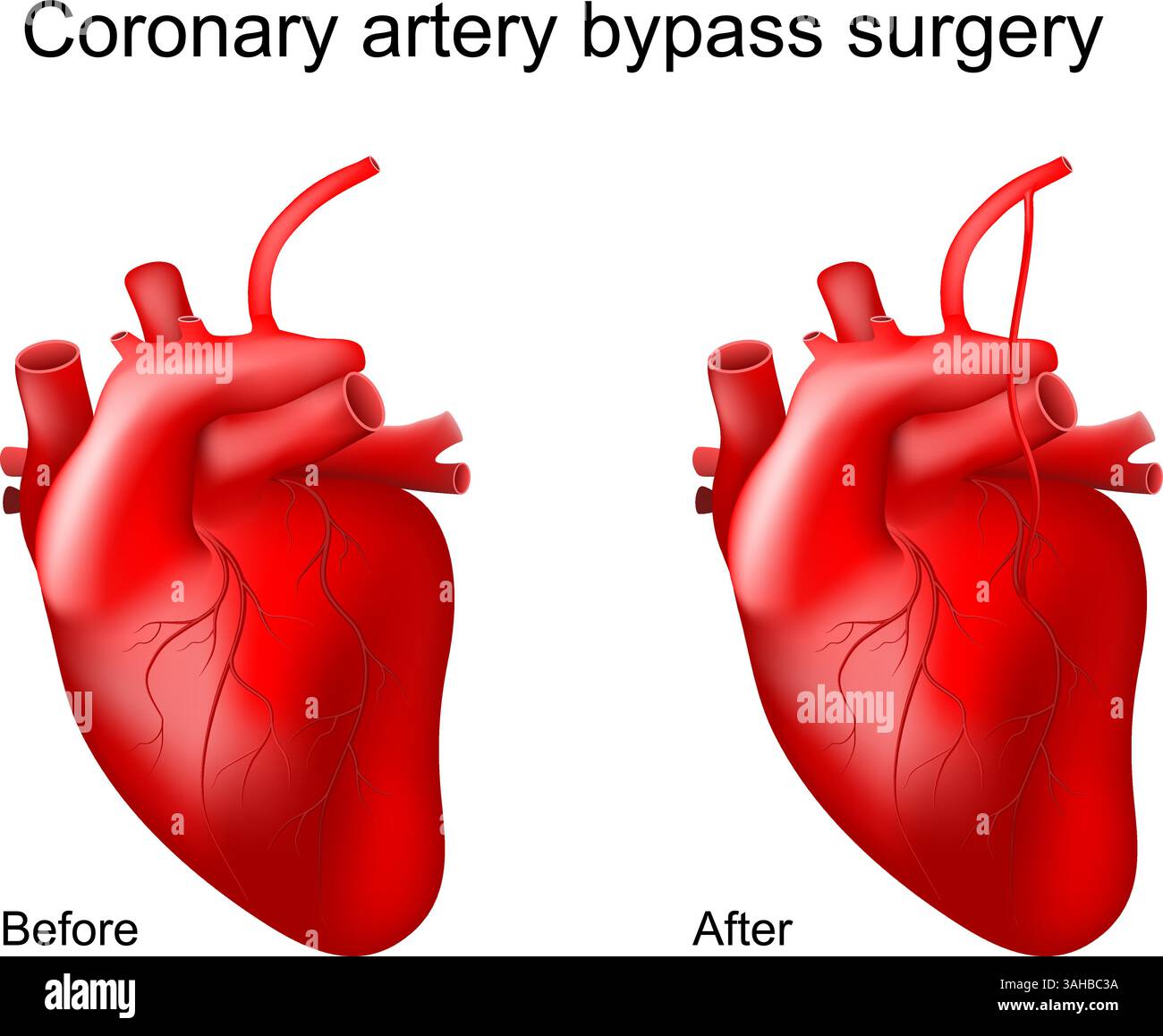 Koronararterien-Bypass. Nahaufnahme eines menschlichen Herzens vor und nach Bypass-Transplantation. Herzchirurgie. Blockierte Arterien. Koronare Herzkrankheit. Myocardi Stock Vektor