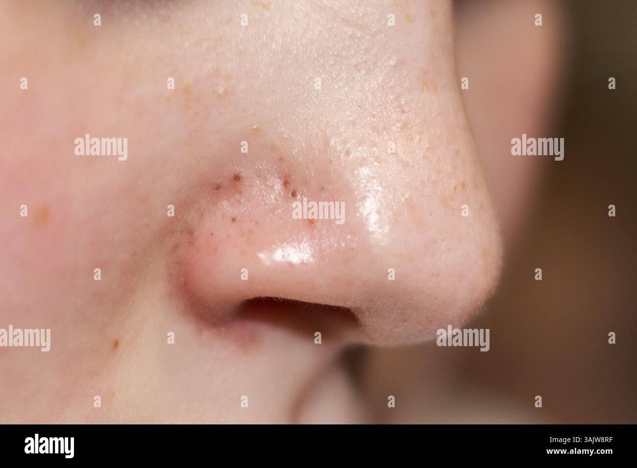 Mitesser nase -Fotos und -Bildmaterial in hoher Auflösung – Alamy, حجم الصورة 1300x956