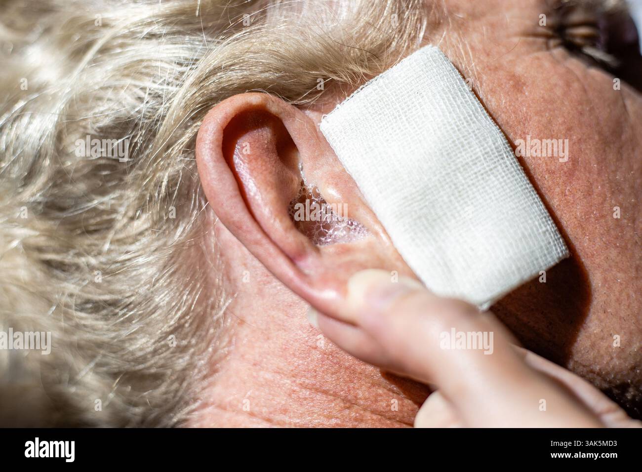 Instillation von Wasserstoffperoxid in das Ohr eines Reifen Mannes zum Ausspülen von Ohrenschmalz. Nahaufnahme des Ohres mit Flüssigkeit und Mulltupfer. Stockfoto Instillation von Wasserstoffperoxid in das Ohr eines Reifen Mannes zum Ausspülen von Ohrenschmalz. Nahaufnahme des Ohres mit Flüssigkeit und Mulltupfer. Stockfoto