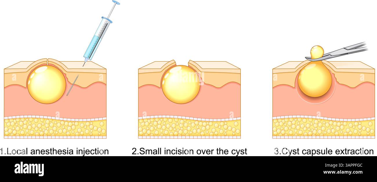 Schritte Zur Entfernung Von Talgzysten. Lokalanästhesie-Injektion, kleiner Schnitt über dem Wachstum und vollständige Kapselextraktion. Minimal-invasive Exzision Stock Vektor