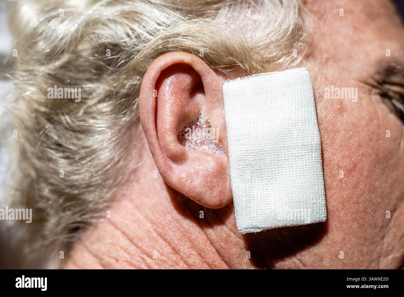 Instillation von Wasserstoffperoxid in das Ohr eines Reifen Mannes zum Ausspülen von Ohrenschmalz. Nahaufnahme des Ohres mit Flüssigkeit und Mulltupfer. Stockfoto Instillation von Wasserstoffperoxid in das Ohr eines Reifen Mannes zum Ausspülen von Ohrenschmalz. Nahaufnahme des Ohres mit Flüssigkeit und Mulltupfer. Stockfoto
