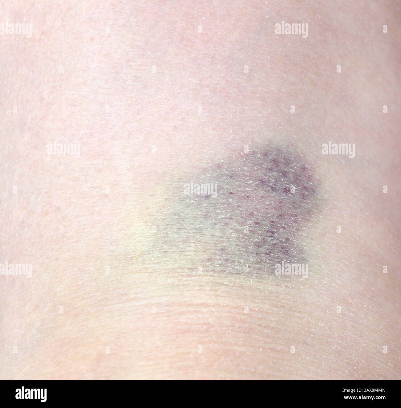 Schließen Sie violette blaue Flecken auf der Haut. Blutergüsse durch Aufprall. Blutergüsse und Hämatome am menschlichen Körper Stockfoto