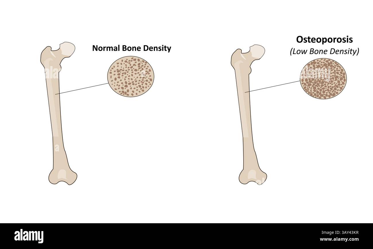 Osteoporosevektorillustration Stock Vektor