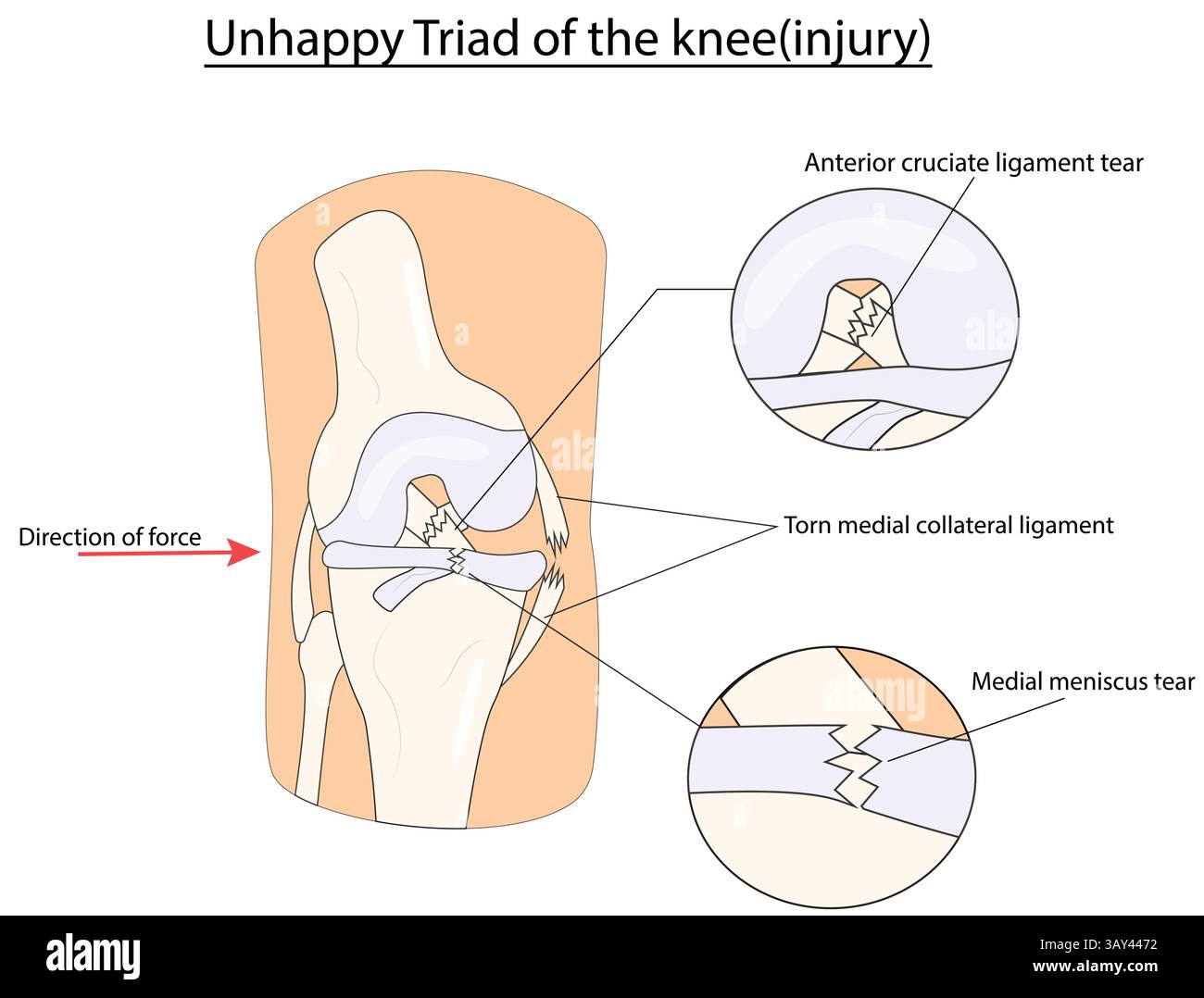 Unglückliche Triade des Knie(Verletzung)-Vektorillustration Stock Vektor Unglückliche Triade des Knie(Verletzung)-Vektorillustration Stock Vektor