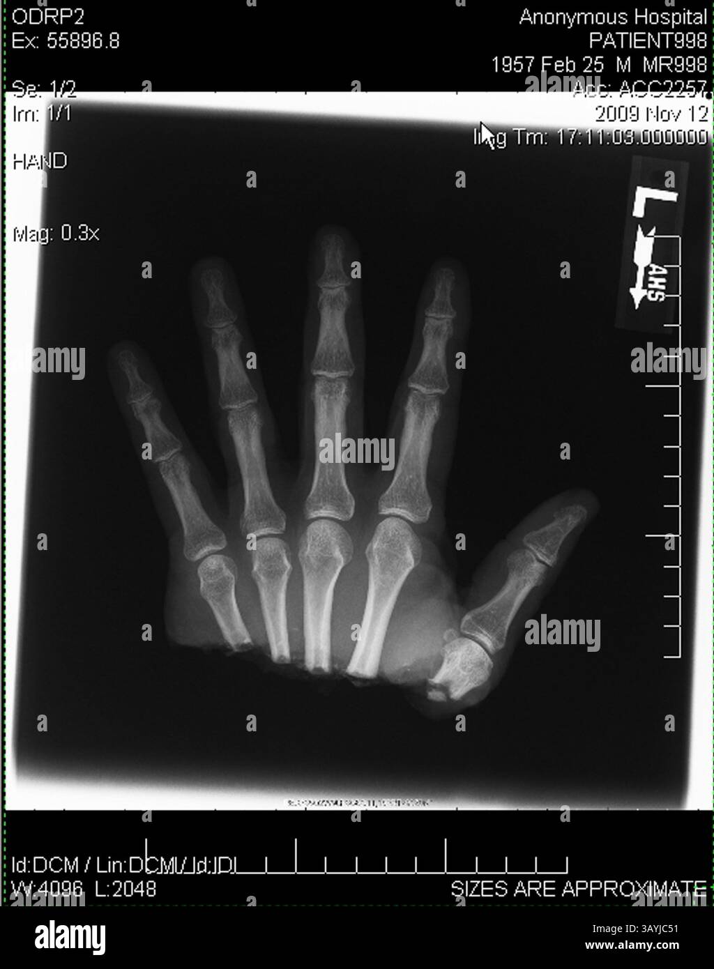 18. Dezember 2009 – Gilbert, Arizona, USA – Ärzte sagen, dass Timothy Blazer durch schnelles Denken seine linke Hand wieder befestigen konnte, nachdem er sie versehentlich mit einer Gehrungssäge durchtrennt hatte. Blazer, 52 Jahre alt, Schnitt ihm die linke Hand ab, während er an Schränken in seinem Haus in Gilbert, Arizona arbeitete. Nach dem Unfall hatte Blazer die Geistesgegenwart, seine abgetrennte Hand zu heben und sie auf Eis zu legen. Blazer sagt, dass sein Hintergrund bei den Pfadfindern und seine Ausbildung als Sicherheitsdirektor für Macy's ihm geholfen haben, ruhig zu bleiben. Chirurgen am Scottsdale Healthcare Hospital haben die Hand in einer vierstündigen Operation wieder befestigt und er hat Bewegung in allen Stockfoto