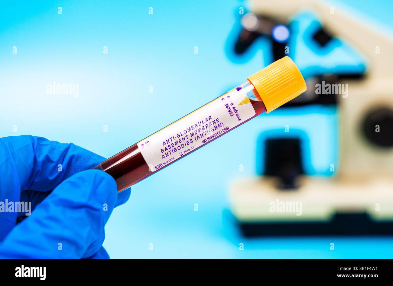 Anti-GAD-Antikörper-Bluttest. Autoimmunmarker. Misst anti-glomeruläre Basalmembran-Antikörper (Anti-GBM-Antikörperspiegel, erhöht bei Krebserkrankungen mit Autoimmunkomponenten, zur Prognose und Überwachung. Stockfoto