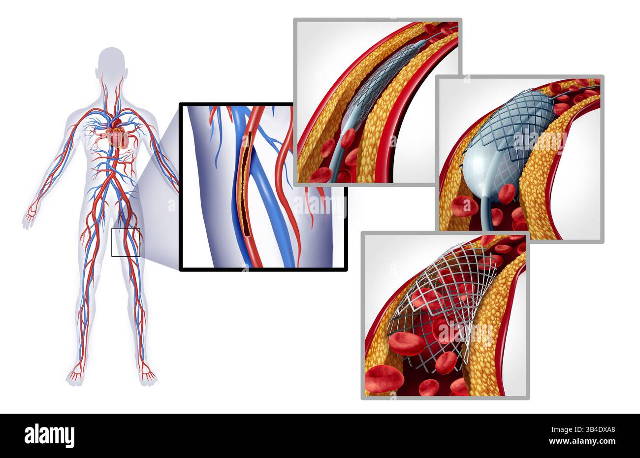 Periphere Arterienangioplastik als Stentoperationsverfahren zur Öffnung verengter oder blockierter Arterien außerhalb des Herzens wie in den Beinen, die Cardi darstellen Stockfoto