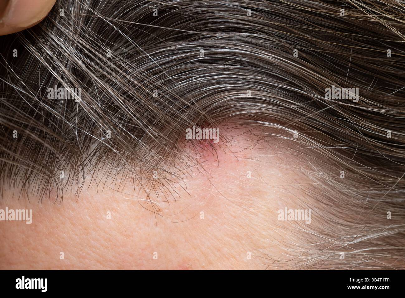 Nahaufnahme des Basalzellkarzinoms auf der Kopfhaut, Hervorhebung des Hautkrebses und dermatologische Untersuchung Stockfoto