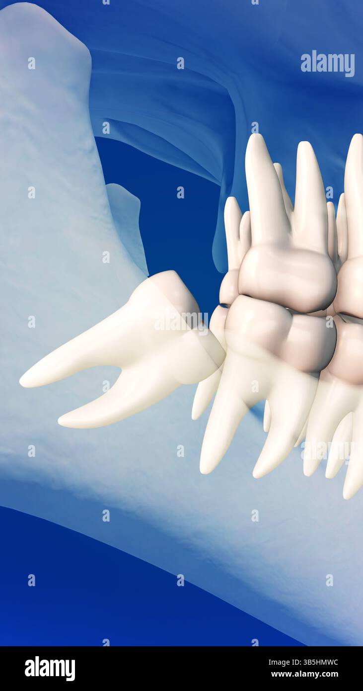 Nahaufnahme des Weisheitszahnschmerzkonzepts Stockfoto