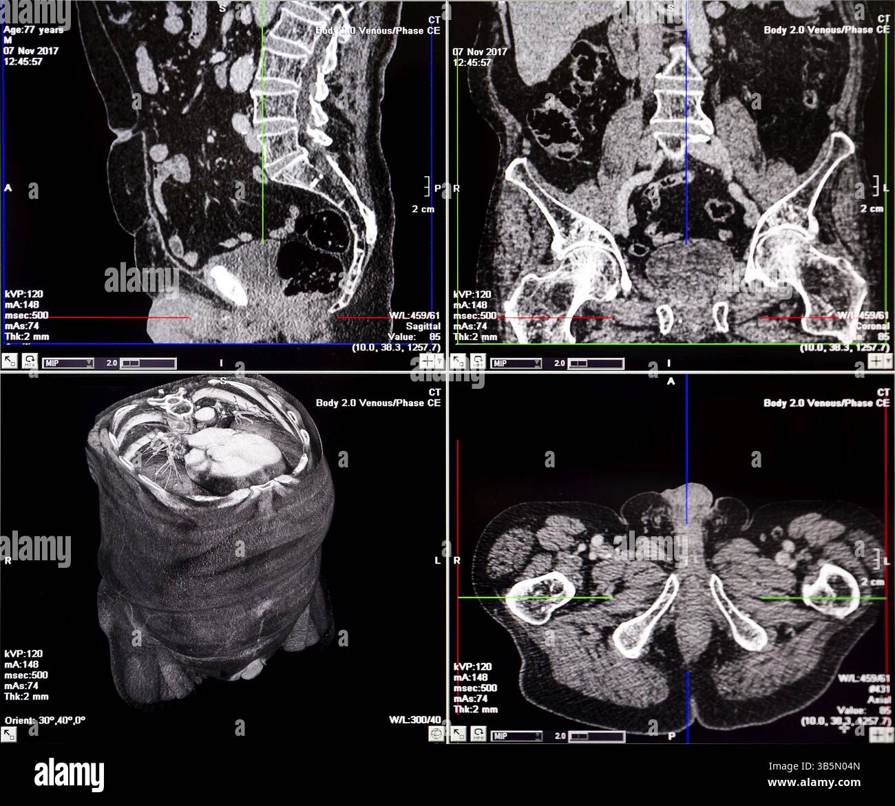 Magnetresonanztomographie (MRT) - CT-Aufnahmen der menschlichen Wirbelsäule auf einem Ultraschall-Computermonitor Stockfoto