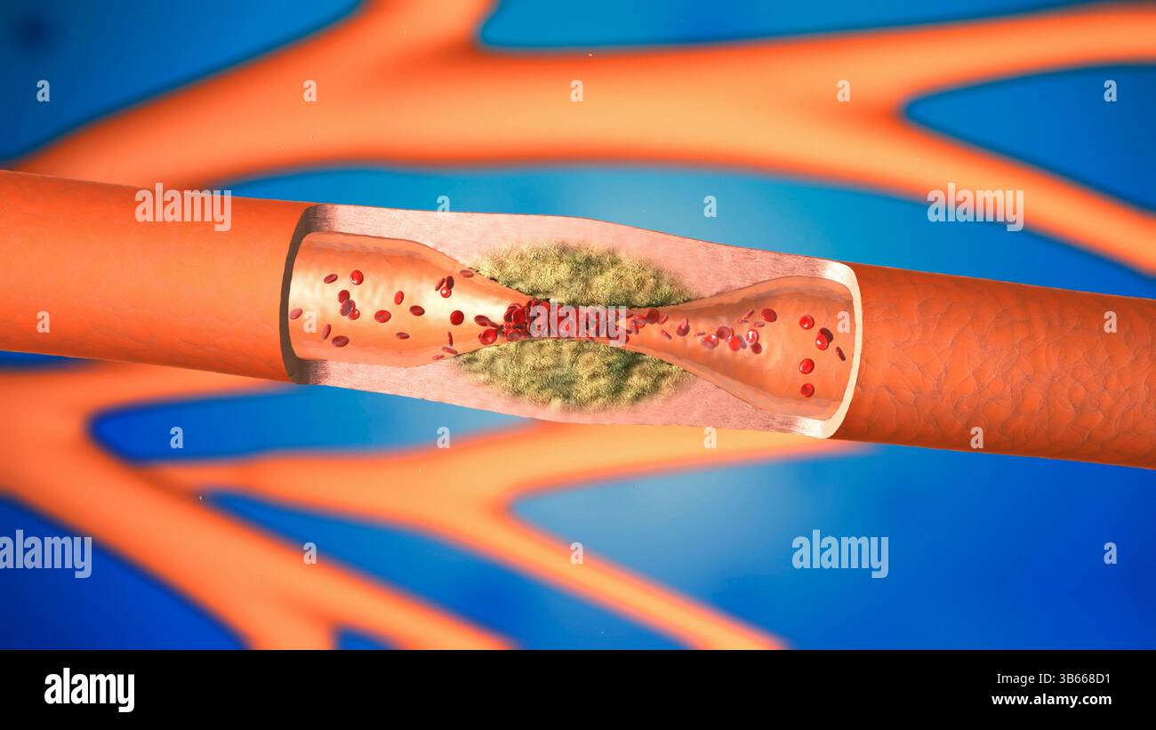 Abbildung des Innern einer Arterie, die von Atherosklerose betroffen ist. Atherosklerose ist eine Verengung (Stenose) einer Arterie aufgrund von Fettablagerungen (gelb) an ihren Innenwänden. Die Ablagerungen bestehen aus Atherom, einer Substanz, die Cholesterin, zerfallende Zellen, Blutzellen und Fettproteine enthält. Eine Verengung der Blutgefäße erhöht den Blutdruck, was das Herz belastet. Die Arteriosklerose der Koronararterien ist die Hauptursache für Herzinfarkte. Stockfoto