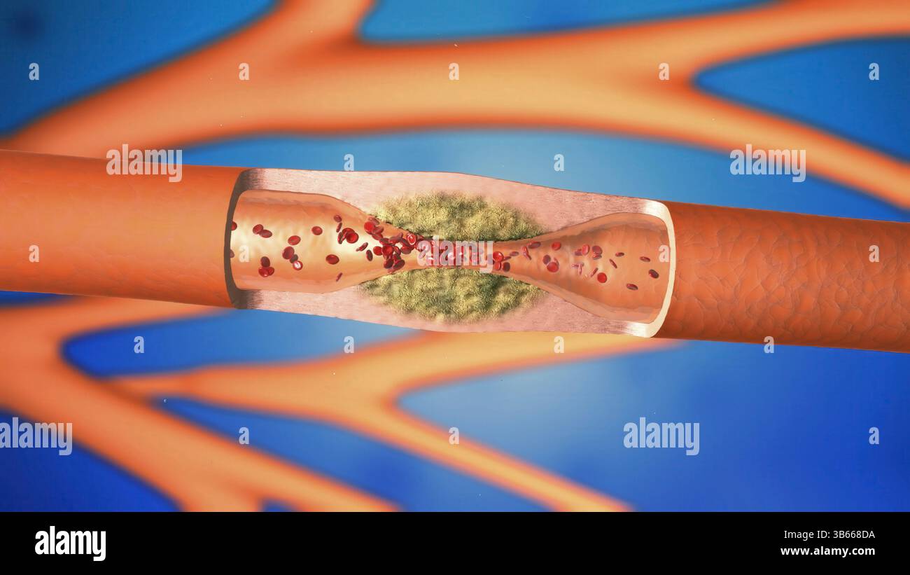 Abbildung des Innern einer Arterie, die von Atherosklerose betroffen ist. Atherosklerose ist eine Verengung (Stenose) einer Arterie aufgrund von Fettablagerungen (gelb) an ihren Innenwänden. Die Ablagerungen bestehen aus Atherom, einer Substanz, die Cholesterin, zerfallende Zellen, Blutzellen und Fettproteine enthält. Eine Verengung der Blutgefäße erhöht den Blutdruck, was das Herz belastet. Die Arteriosklerose der Koronararterien ist die Hauptursache für Herzinfarkte. Stockfoto