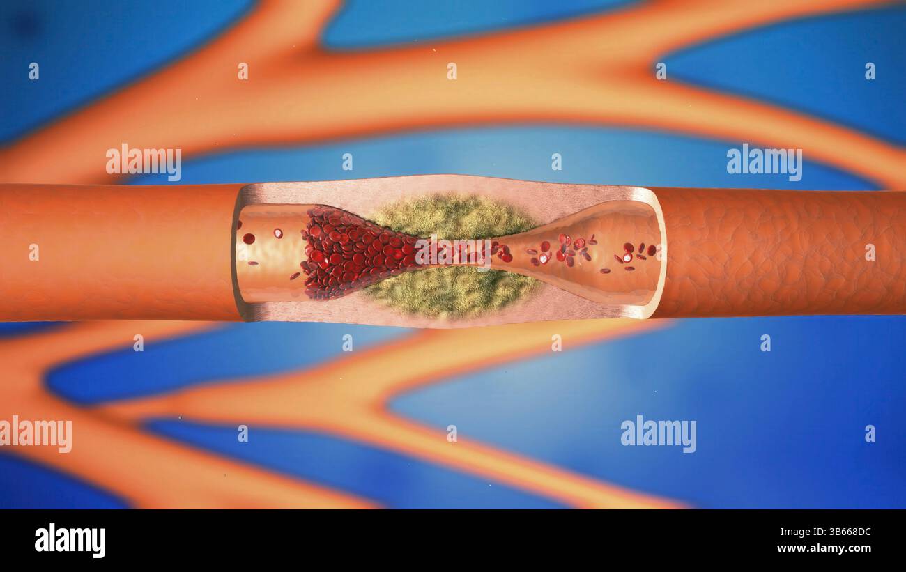 Abbildung des Innern einer Arterie, die von Atherosklerose betroffen ist. Atherosklerose ist eine Verengung (Stenose) einer Arterie aufgrund von Fettablagerungen (gelb) an ihren Innenwänden. Die Ablagerungen bestehen aus Atherom, einer Substanz, die Cholesterin, zerfallende Zellen, Blutzellen und Fettproteine enthält. Eine Verengung der Blutgefäße erhöht den Blutdruck, was das Herz belastet. Die Arteriosklerose der Koronararterien ist die Hauptursache für Herzinfarkte. Stockfoto