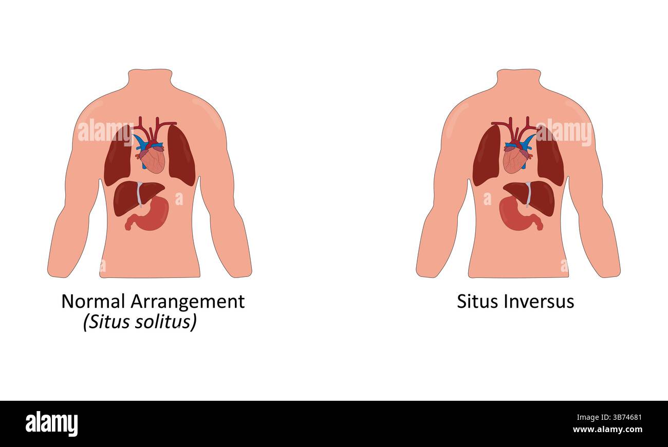 Situs inversus Vektor-Illustration Stock Vektor