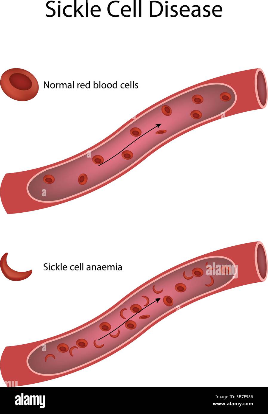 Sichelzellkrankheit Erythrozyten und Sichelzellanämie in den Blutgefäßen, Vektor-Illustration Stock Vektor