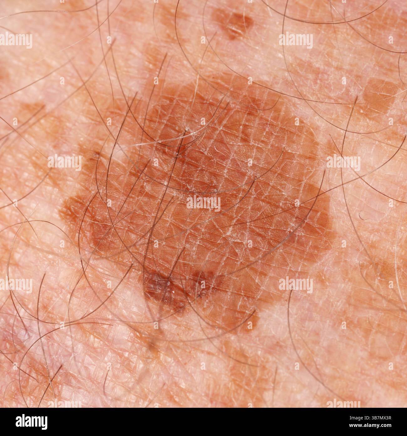 Sommersprossen und grosse Hautflecken am Bein des älteren Mannes. Stockfoto