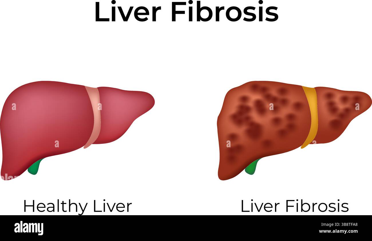 Leberfibrose gesund vs erkrankte Leber Design Vektor Illustration Stock Vektor