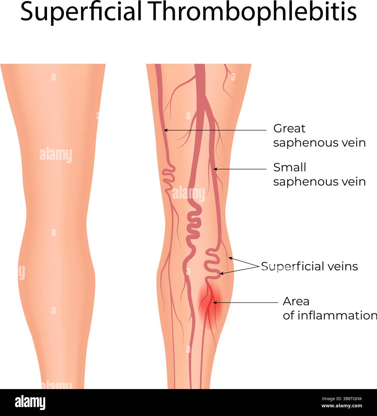 Oberflächliche Thrombophlebitis Eine medizinische Darstellung der Venenentzündung im Beinvektor Stock Vektor