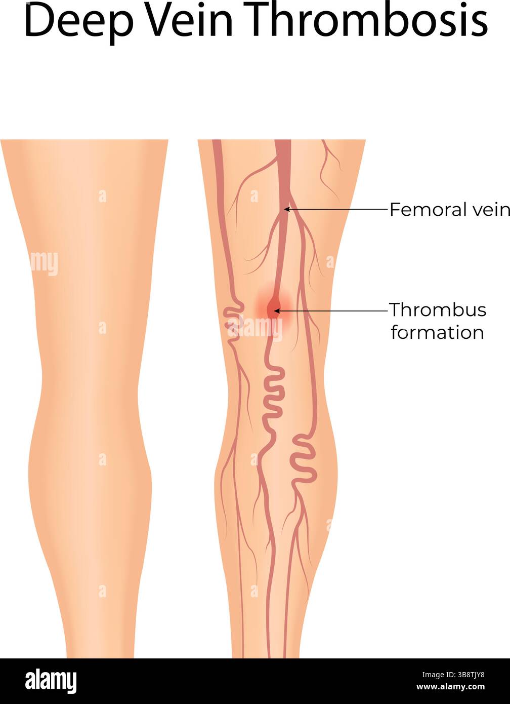 Tiefe Venenthrombose Blutgerinnsel in der Vektor-Illustration verstehen Stock Vektor