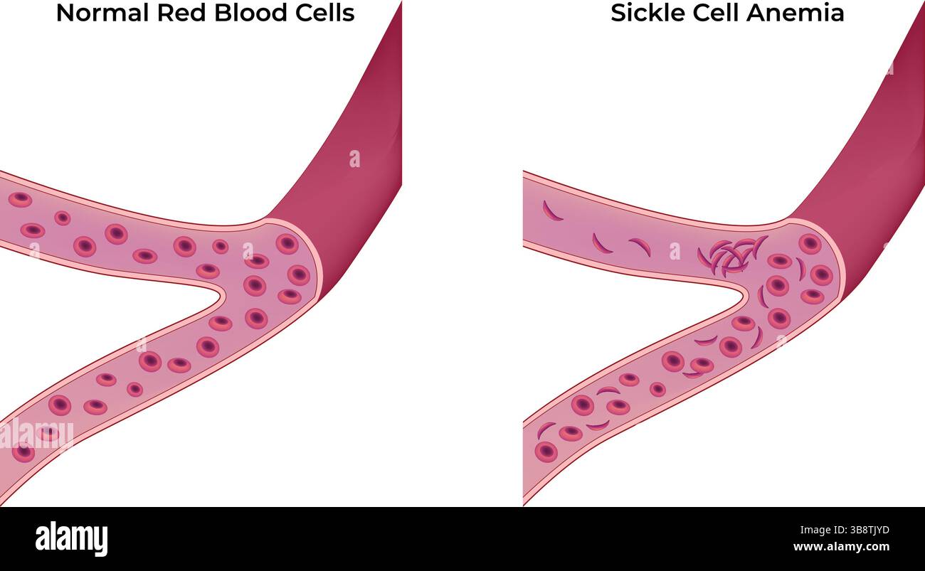 Vergleich normaler Erythrozyten und Sichelzellanämie Vektorillustration Stock Vektor