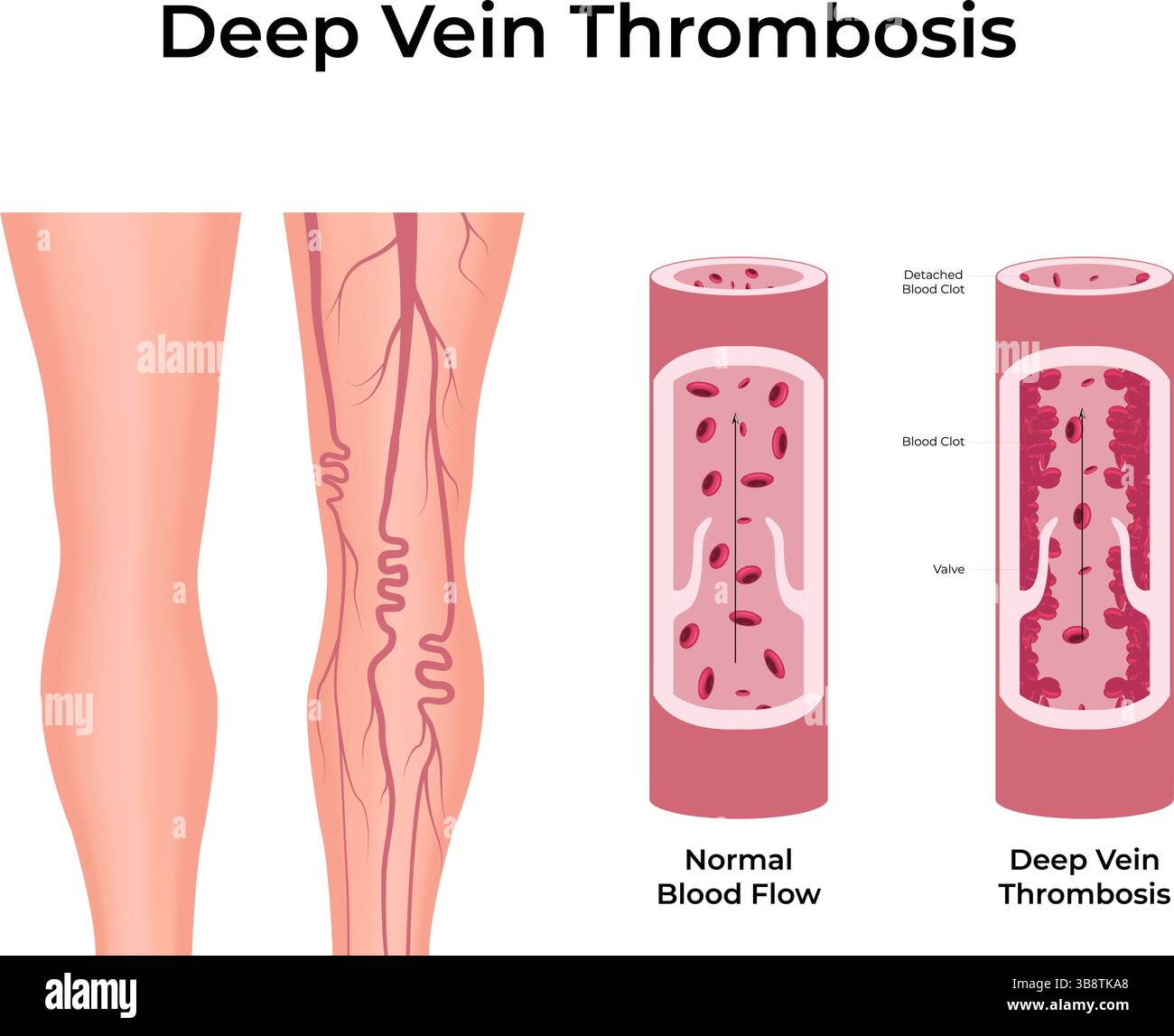 Tiefe Venenthrombose Blutgerinnsel in der Vektor-Illustration verstehen Stock Vektor