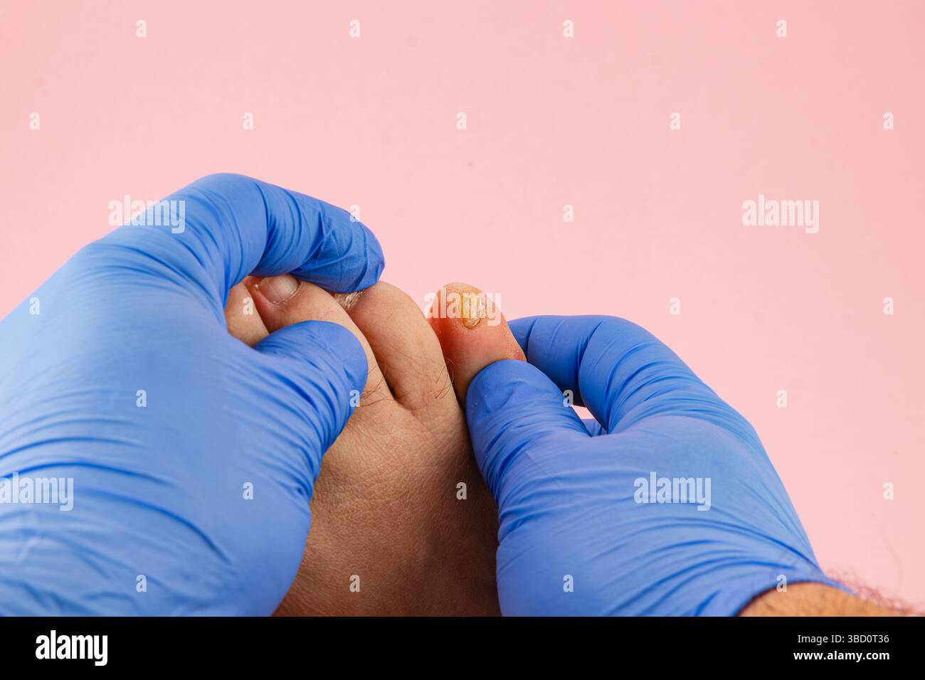 Eine Person, die blaue Handschuhe trägt, untersucht einen verletzten Zeh vorsichtig vor einem rosafarbenen Hintergrund. Der Fokus liegt auf dem Zustand der Zehen und dem sorgfältigen Herangehen Stockfoto