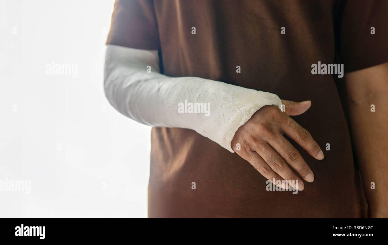 Eine Nahaufnahme des Arms einer Person, umhüllt von einem weißen Gipsguss, der sich direkt unter dem Ellenbogen erstreckt, um die Hand zu bedecken, wobei die Finger freigelegt sind. Stockfoto