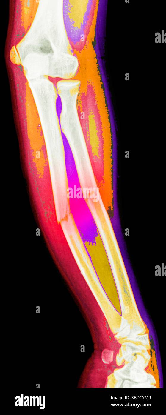 Farbiges Röntgenbild eines Unterarms mit Frakturen sowohl der Ulna als auch des Radiusknochens. Stockfoto