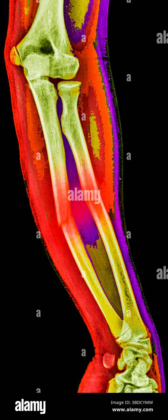 Farbiges Röntgenbild eines Unterarms mit Frakturen sowohl der Ulna als auch des Radiusknochens. Stockfoto