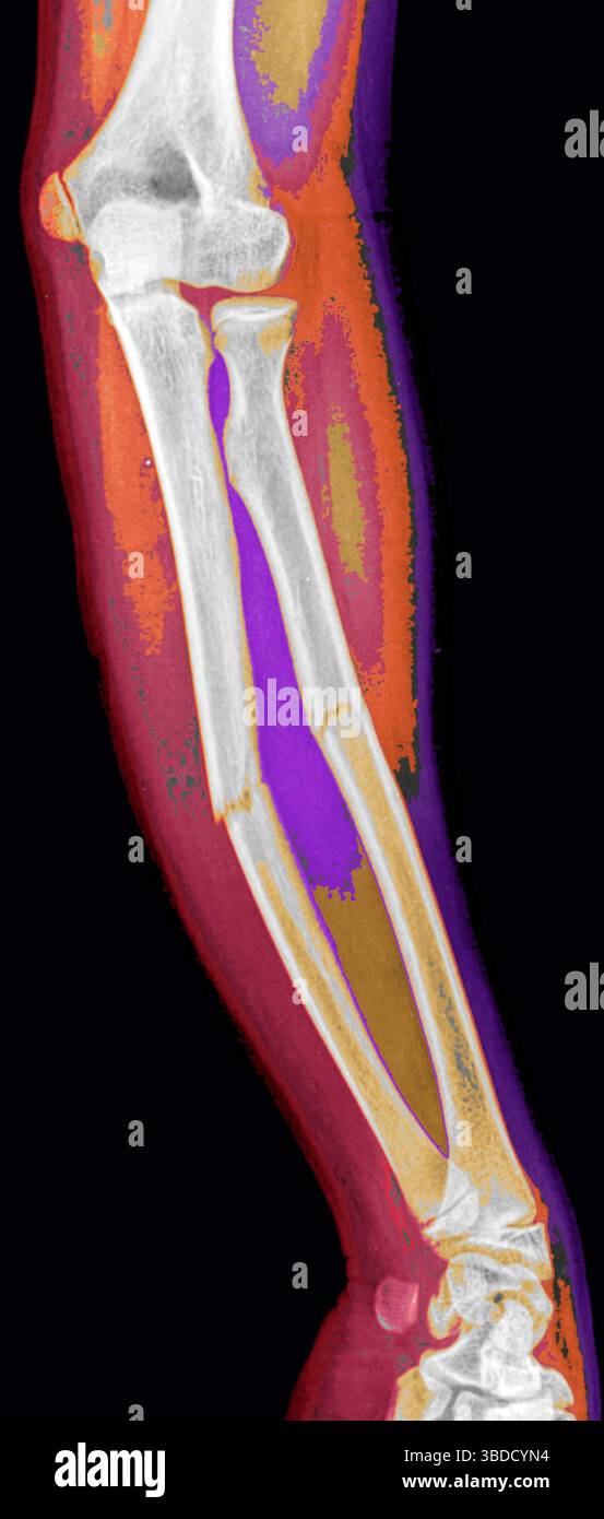 Farbiges Röntgenbild eines Unterarms mit Frakturen sowohl der Ulna als auch des Radiusknochens. Stockfoto