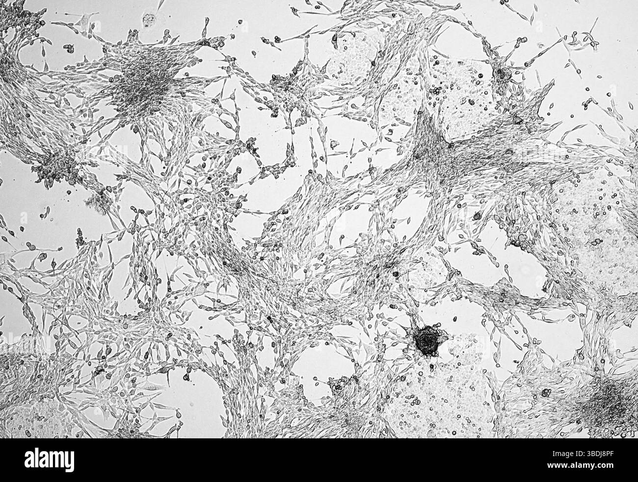 Glioblastom-Zellkultur. Humane maligne Astrozytomzellen unter dem Mikroskop. Stockfoto