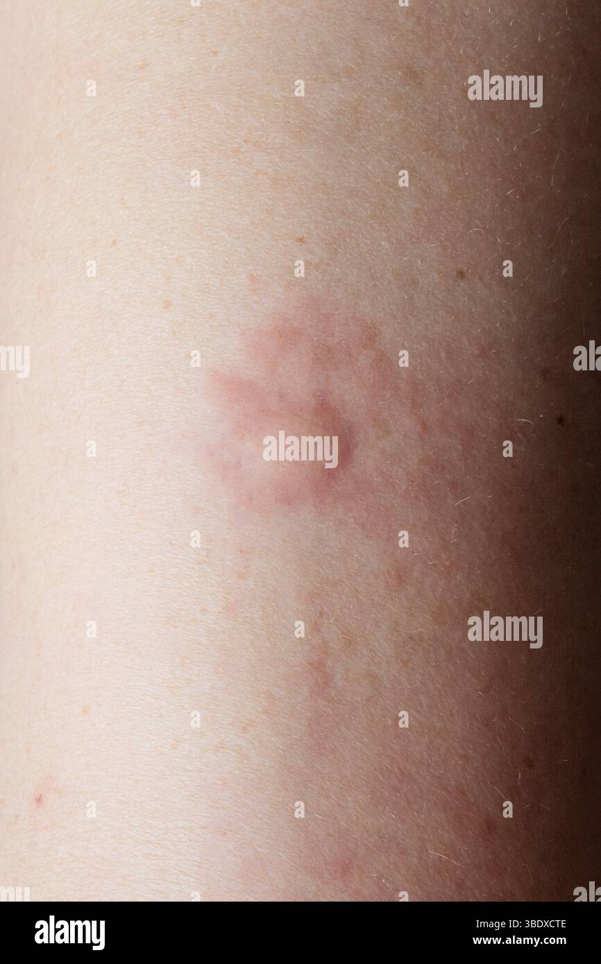 Pilzinfektion verursacht kreisförmigen Ausschlag auf der Haut, zeigt Symptome von Ringelflechte Stockfoto