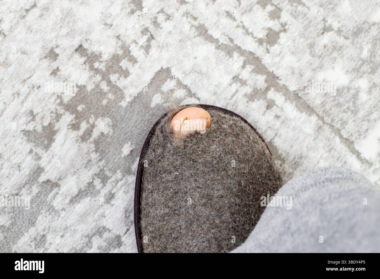Filz-Slipper mit Lochschäden und Zehennagel auf grauem Teppichhintergrund, Armutskonzept Stockfoto