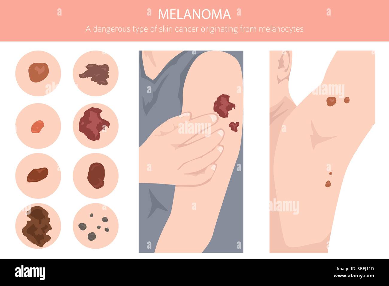 Melanom. Hautkrankheiten. Medizinische Infografik. Vektorabbildung Stock Vektor