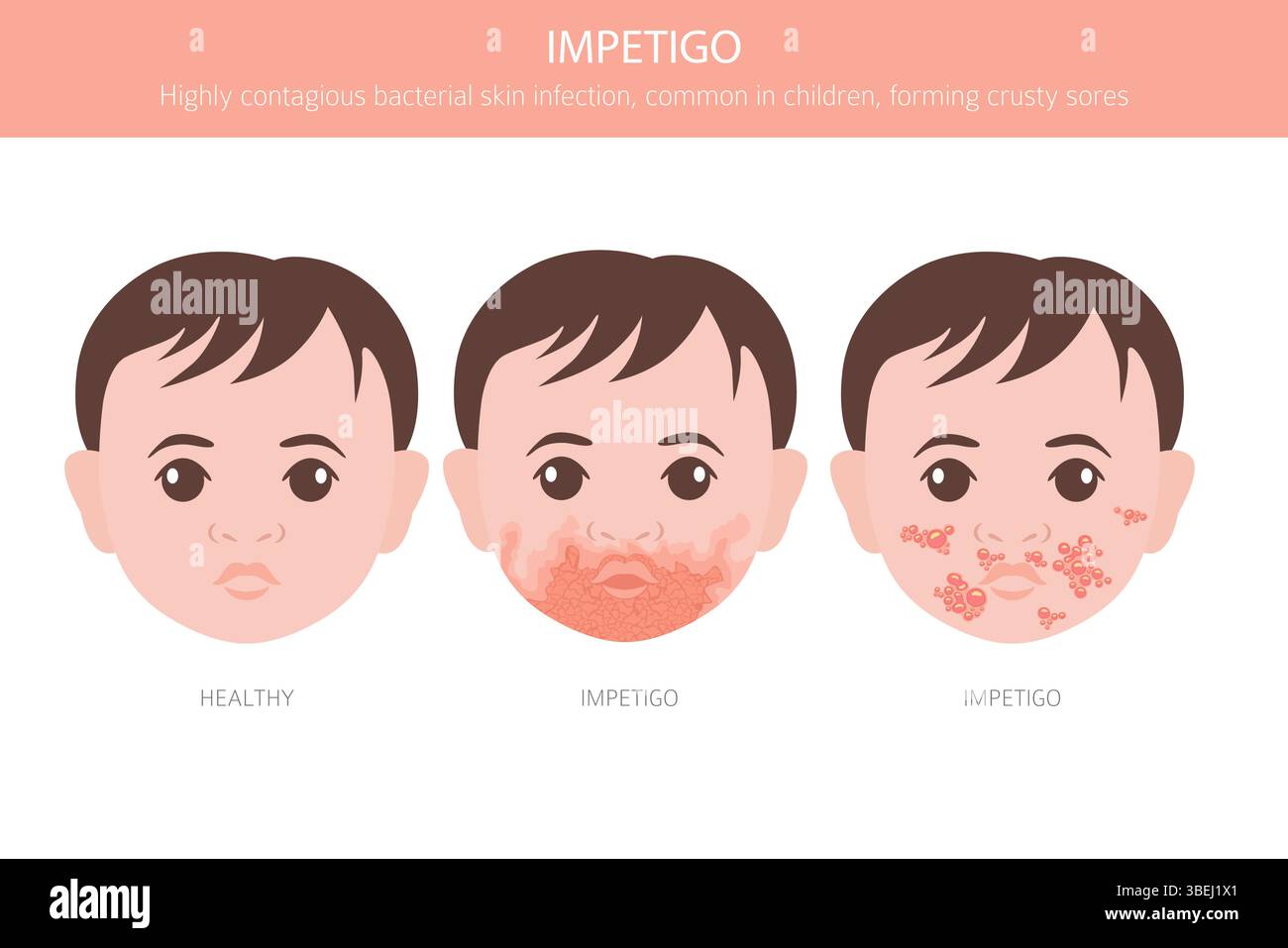Impetigo. Hautkrankheiten. Medizinische Infografik. Vektorabbildung Stock Vektor