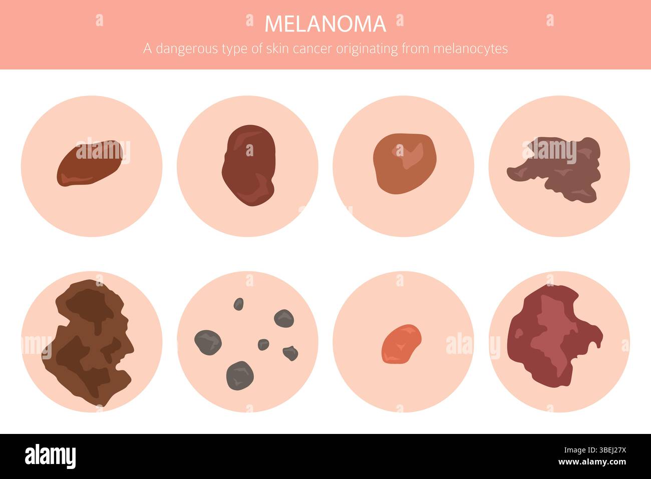 Melanom. Hautkrankheiten. Medizinische Infografik. Vektorabbildung Stock Vektor