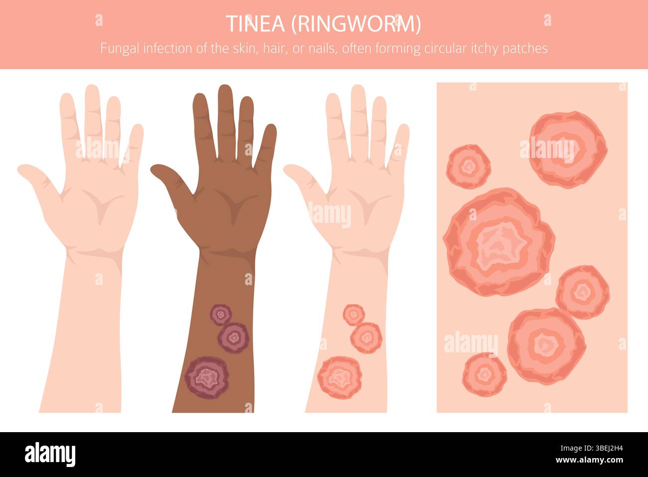 Tinea. Ringelflechte. Hautkrankheiten. Medizinische Infografik. Vektorabbildung Stock Vektor