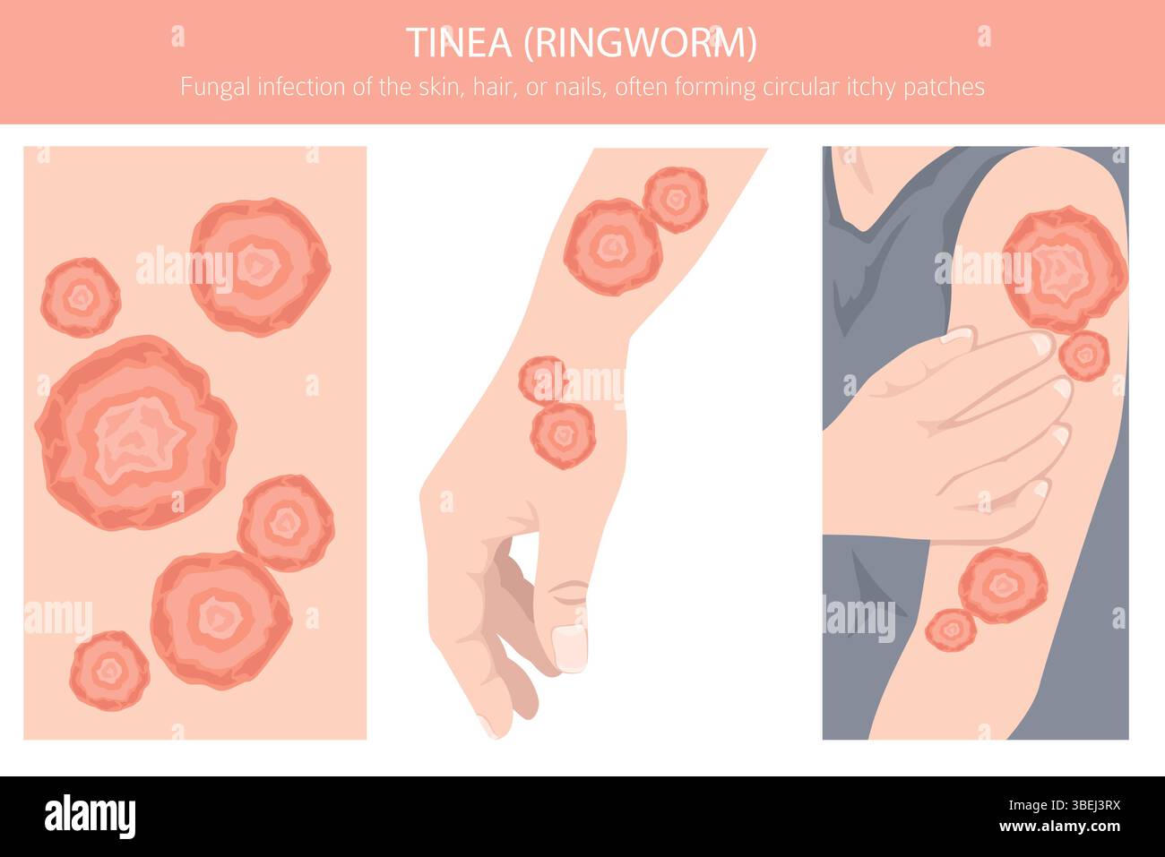Tinea. Ringelflechte. Hautkrankheiten. Medizinische Infografik. Vektorabbildung Stock Vektor