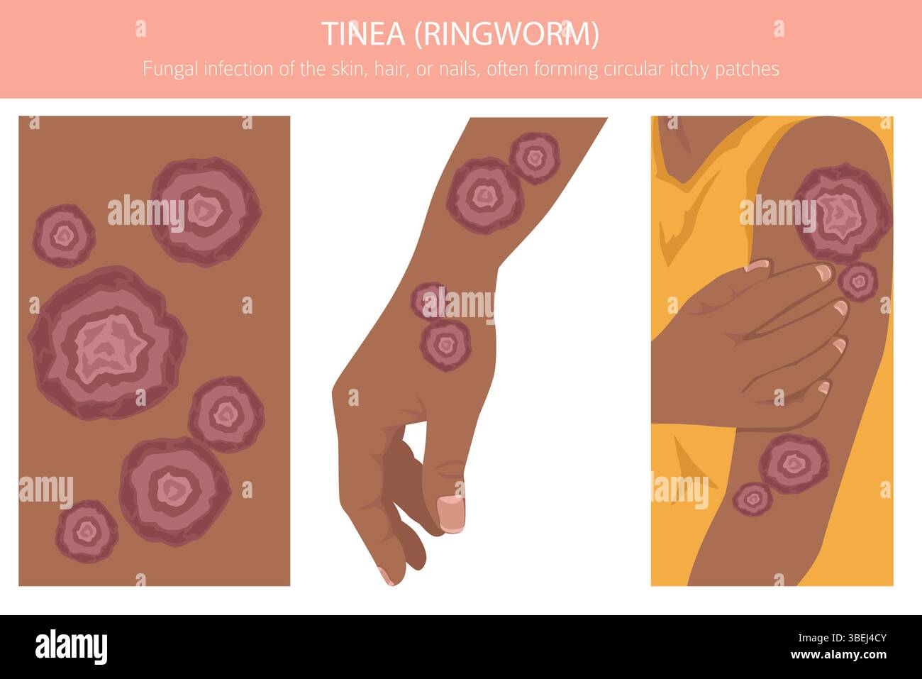 Tinea. Ringelflechte. Hautkrankheiten. Medizinische Infografik. Vektorabbildung Stock Vektor
