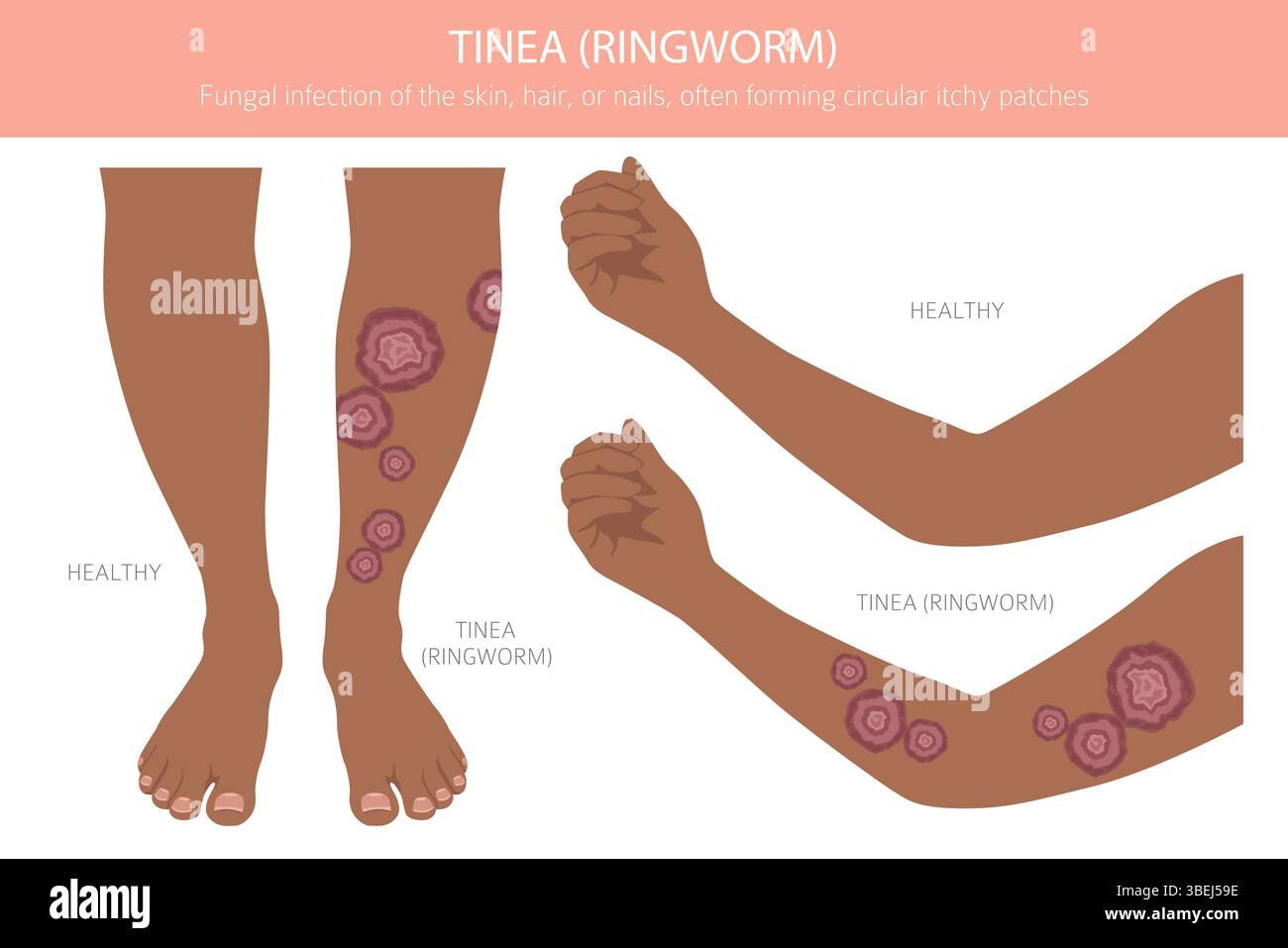 Tinea. Ringelflechte. Hautkrankheiten. Medizinische Infografik. Vektorabbildung Stock Vektor