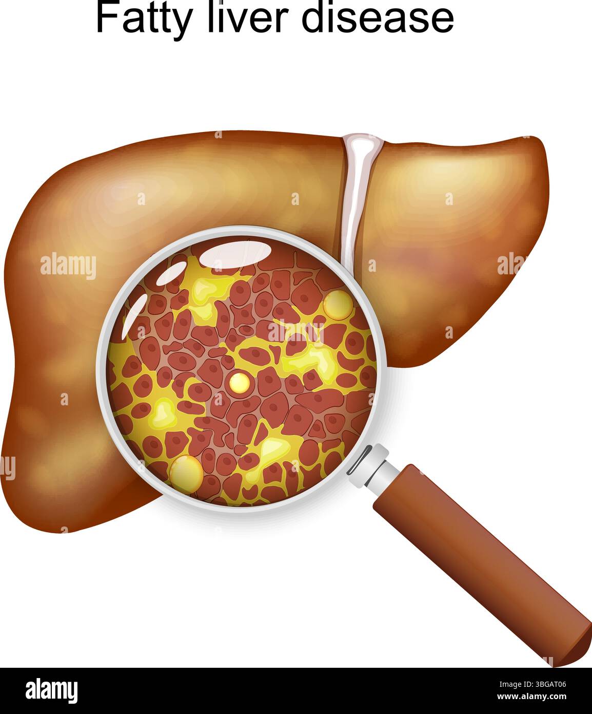 Die Fettlebererkrankung. Hepatische Steatose. Unter einer Lupe lagern sich Zellen und überschüssiges Fett in der Leber an. Schematische Darstellung. Medizinisches Diagramm. Stock Vektor