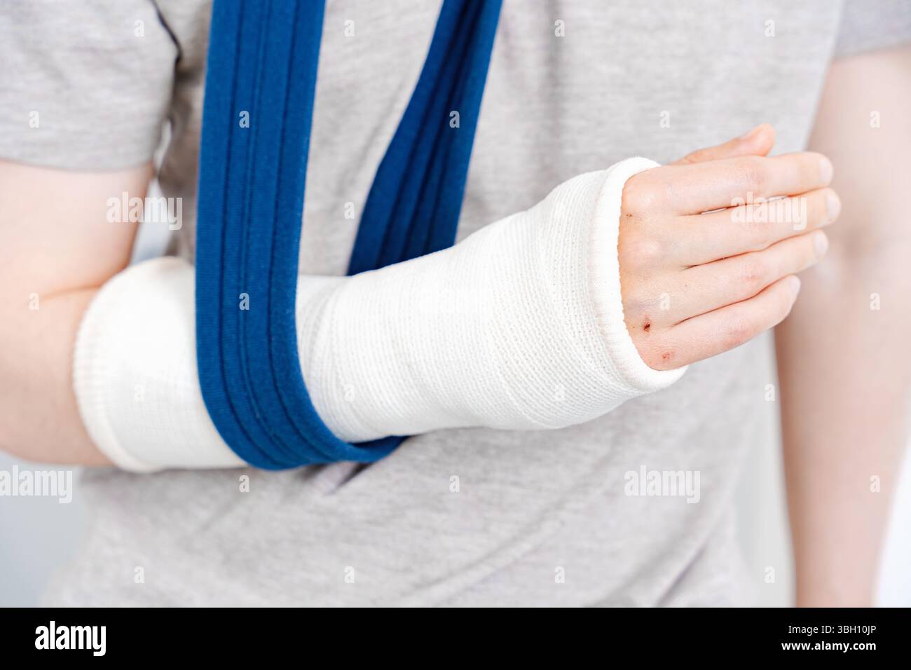 Nahaufnahme eines gebrochenen Arms in einem orthopädischen Guss gestützt durch eine blaue Schlinge, Verletzungsbereinigung, Gesundheitsfürsorge Stockfoto