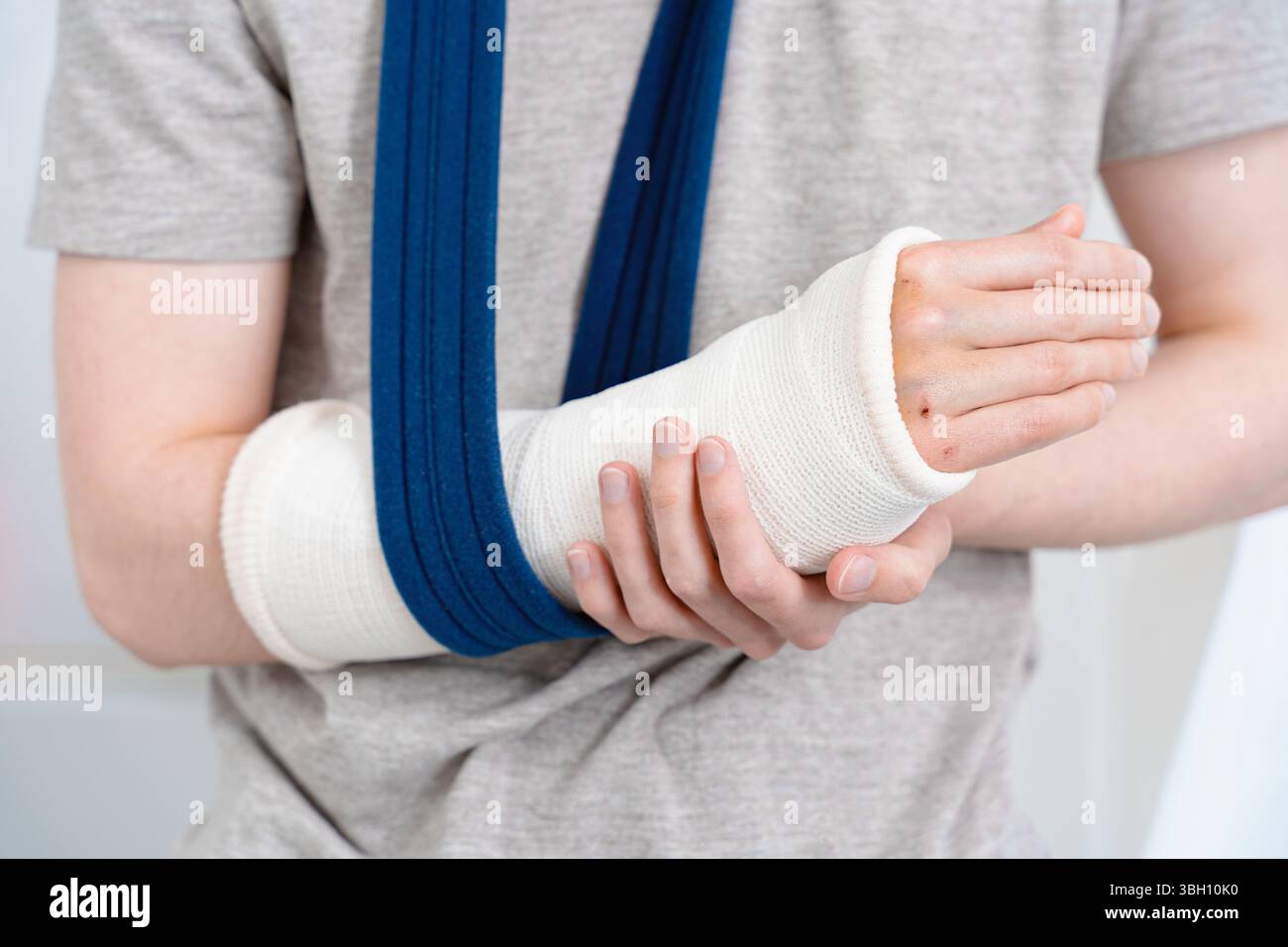 Eine Person mit einem gebrochenen Arm in einem weißen Gips hält ihn sanft mit der anderen Hand, unterstützt durch Schlinge, Gesundheit, Verletzung und Knochenerholung Stockfoto