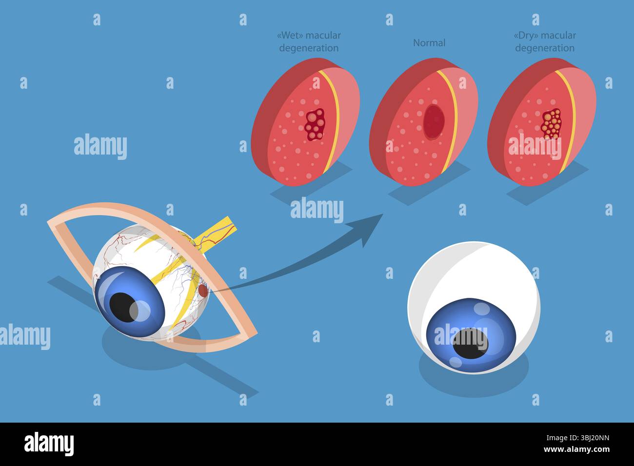 3D Isometrische flache Darstellung altersbedingter Makuladegeneration, Augenkrankheit, Sehproblem Stockfoto