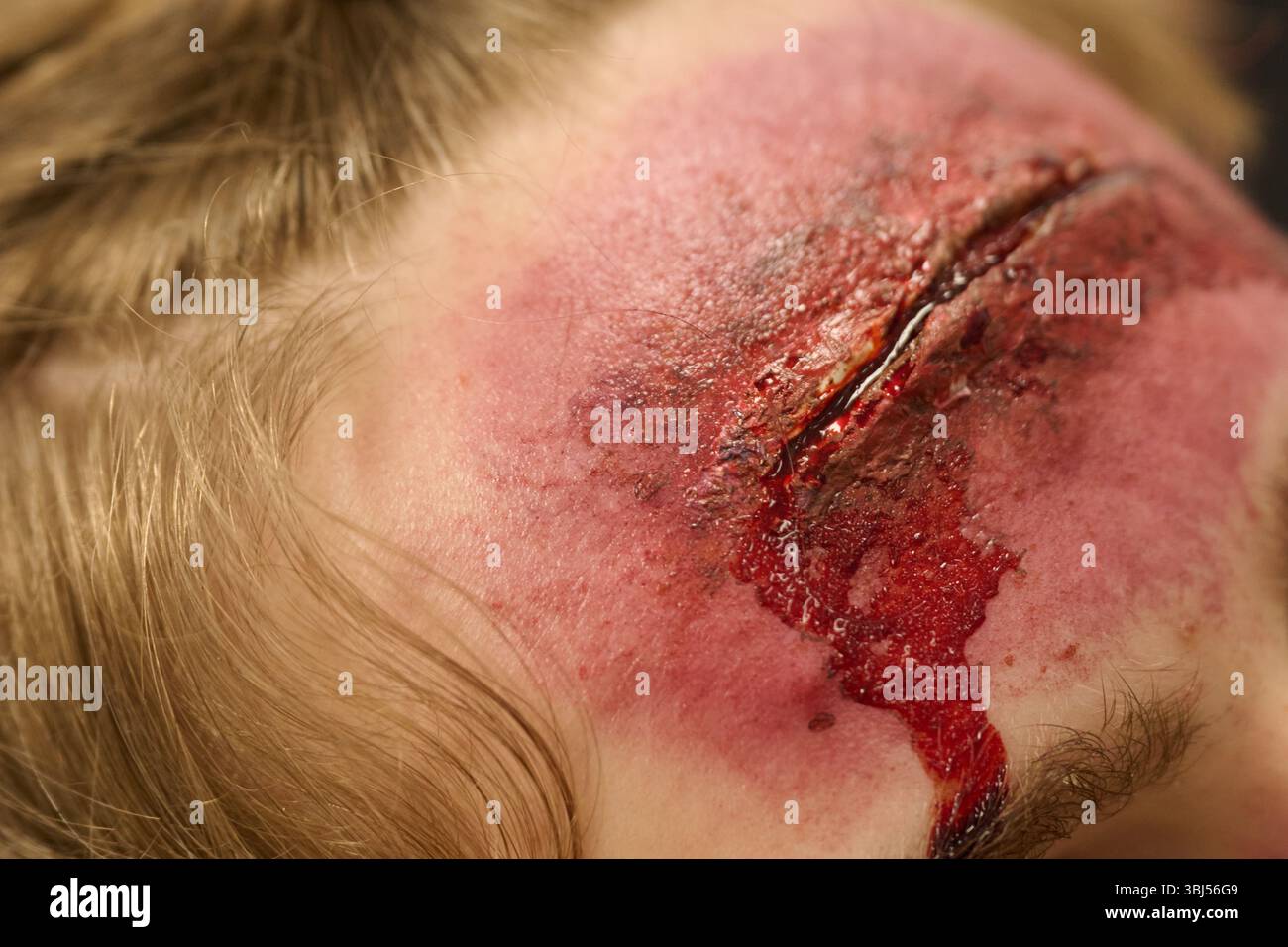 Nahaufnahme einer tiefen und blutigen Kopfwunde, die die Schwere der Verletzung und die Notwendigkeit einer sofortigen medizinischen Versorgung unterstreicht Stockfoto