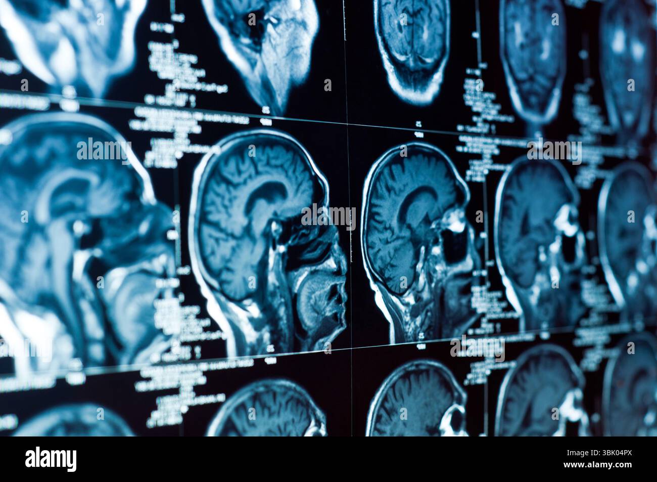 Nahaufnahme eines CT-Scans mit Gehirn und Schädel darauf Stockfoto