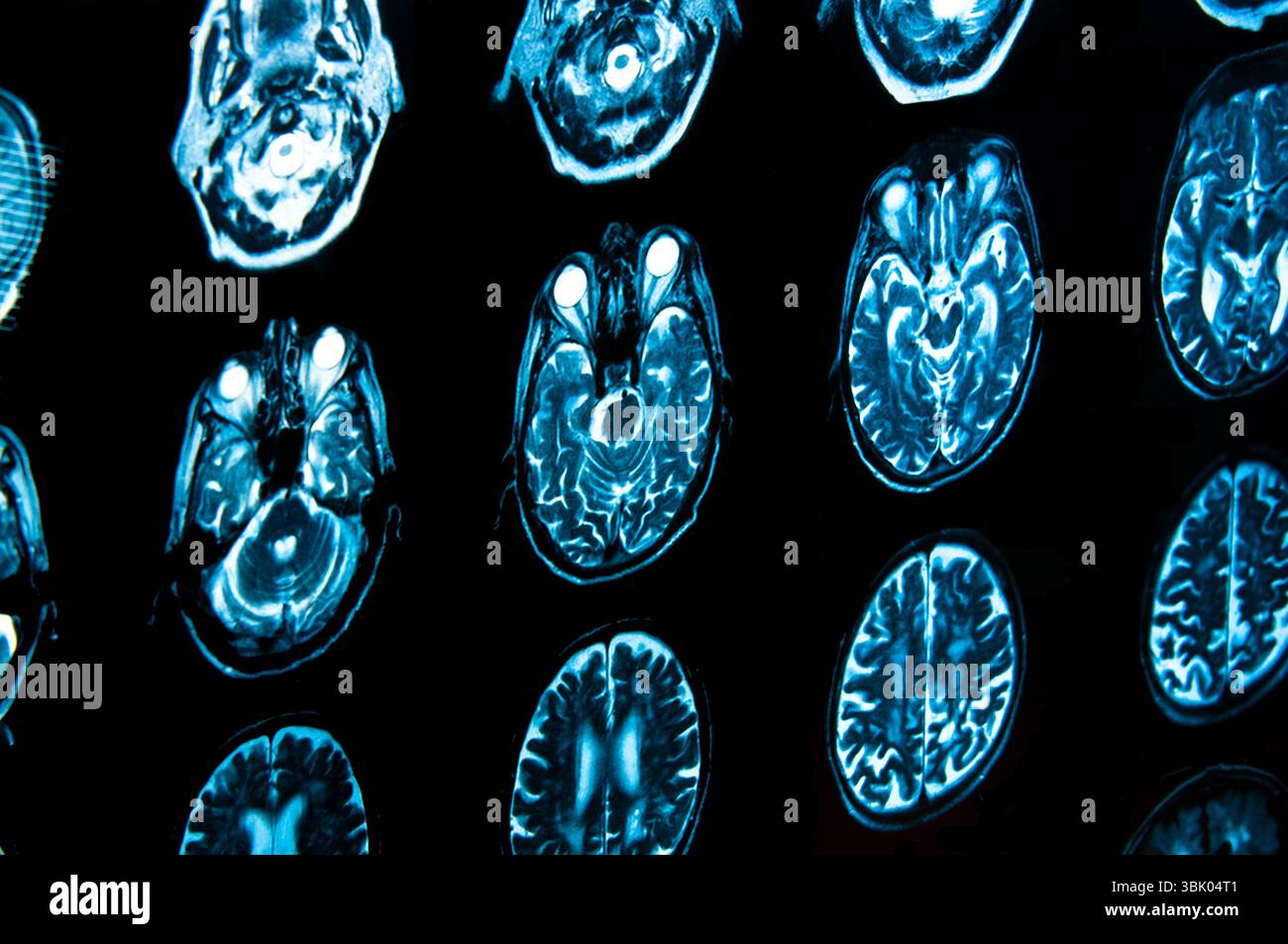 Nahaufnahme einer axialen Computertomographie (CAT-Scan) Stockfoto