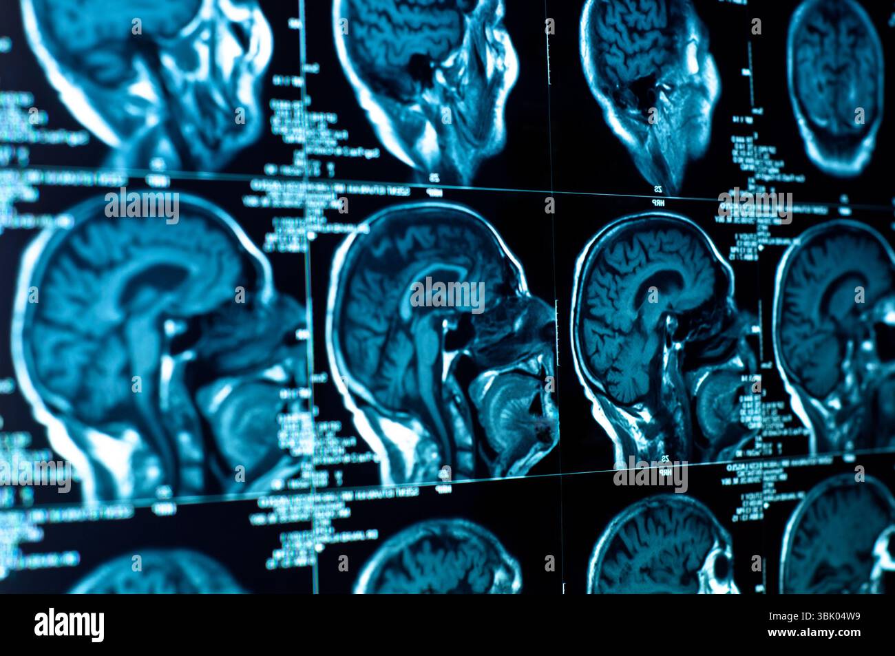 Nahaufnahme eines CT-Scans mit Gehirn Stockfoto